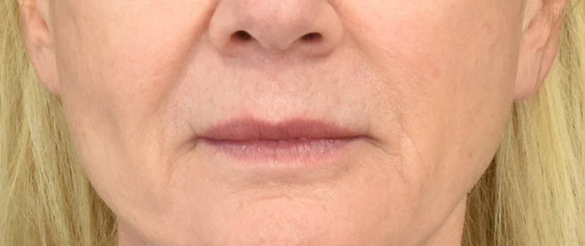 Lip Lift Patient 12 Set 1 Before